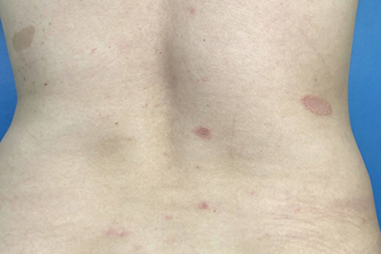 玫瑰糠疹背部斑图