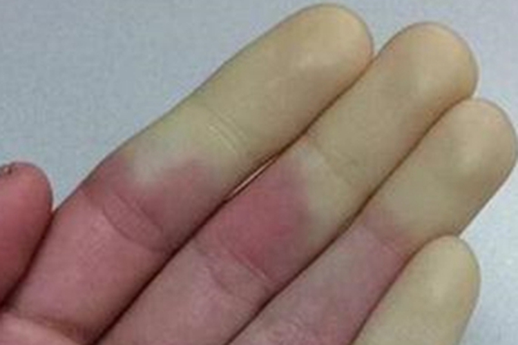 手足发绀症手指症状图 手足发绀症手指症状图