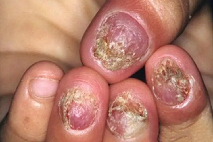 慢性黏膜皮肤念珠菌病萎缩图