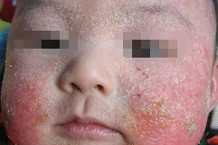 婴儿期特应性皮炎面部症状图