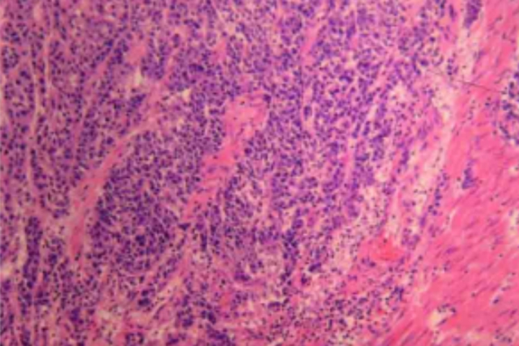 低分化管状腺癌组织病理图