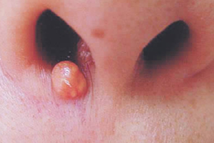 皮脂腺腺瘤圆疙瘩图