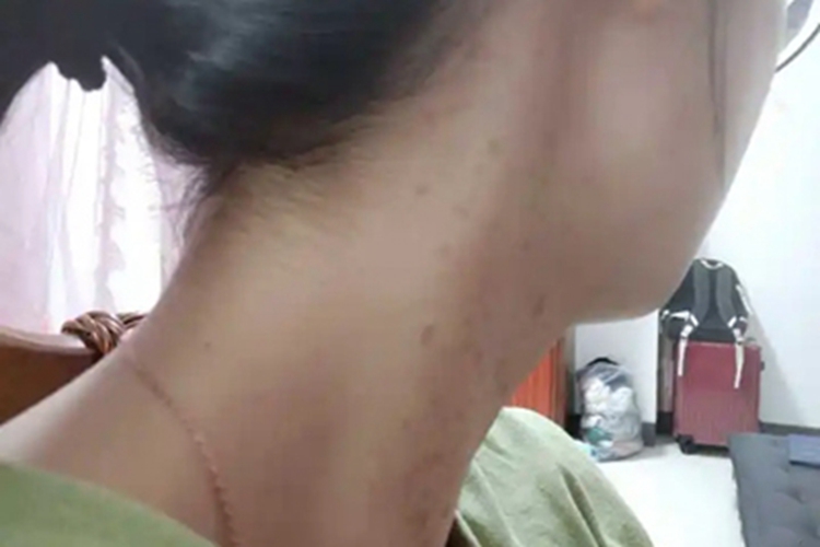 雀斑侧颈部长了黄褐色斑点图