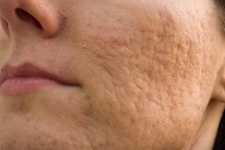 痤疮皮肤凹陷萎缩图