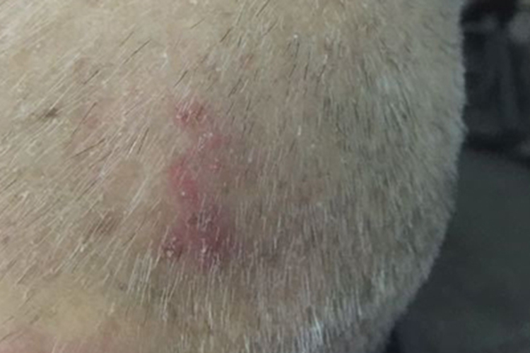 头癣头皮小红疙瘩图 头癣头皮小红疙瘩图