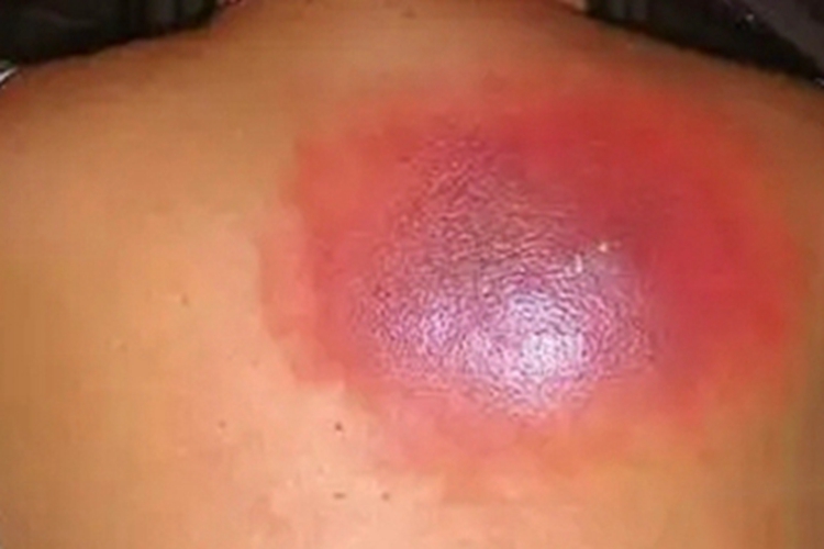 急性网状淋巴管炎背部红斑图