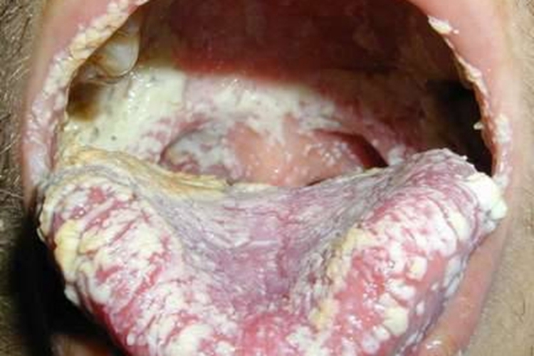 艾滋病急性感染期口腔症状图