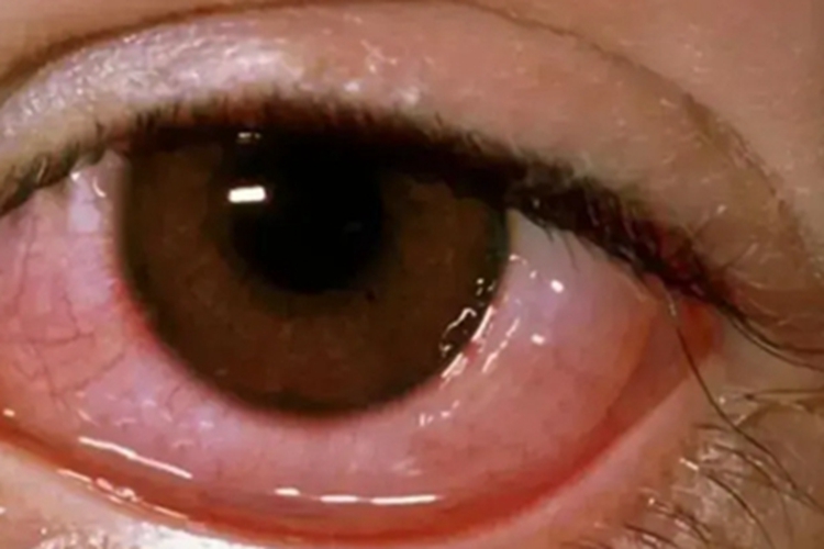 巨乳头性结膜炎结膜充血图