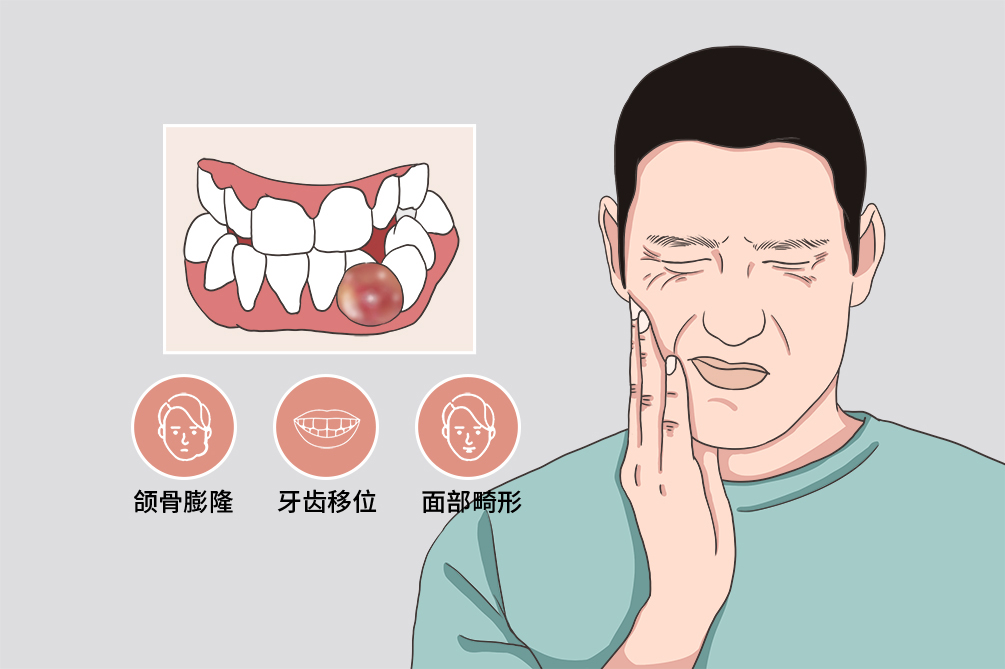 頜骨囊腫