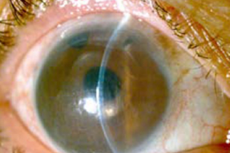 大泡性角膜病变眼球发白图
