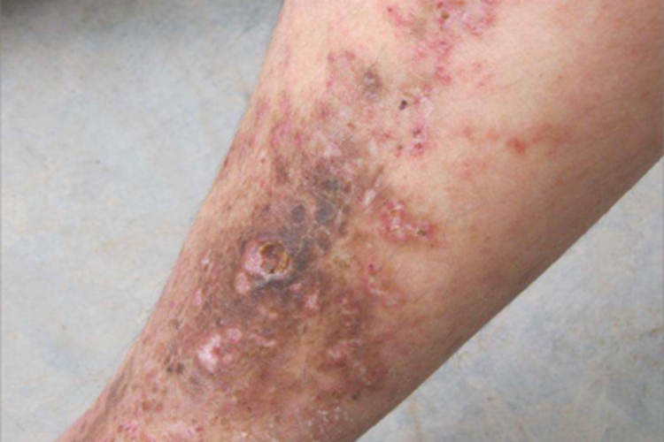 淤积性皮炎小腿皮肤发黑图