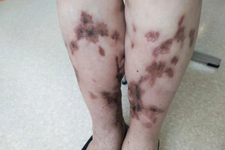 结节性脂膜炎小腿坑图 结节性脂膜炎小腿坑图