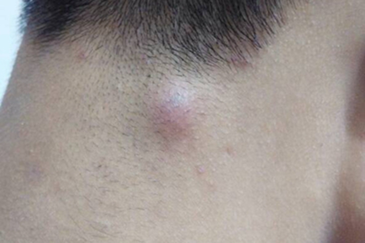 疖后颈大疙瘩图 疖后颈大疙瘩图