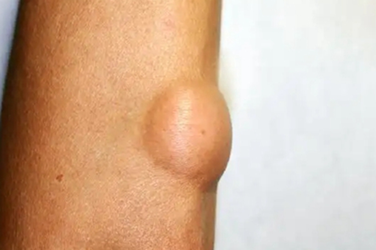 皮肤猪囊虫病包块图 皮肤猪囊虫病包块图