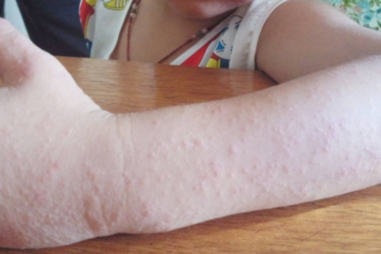 孩子沙土皮炎图