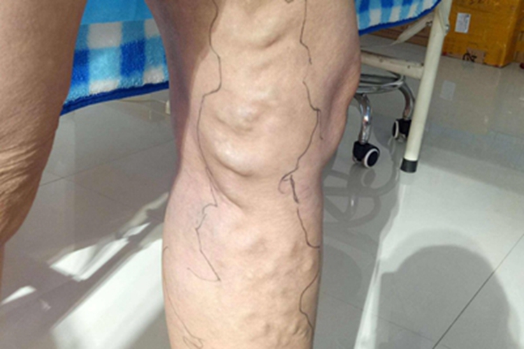 大隐静脉曲张腿凹凸不平图