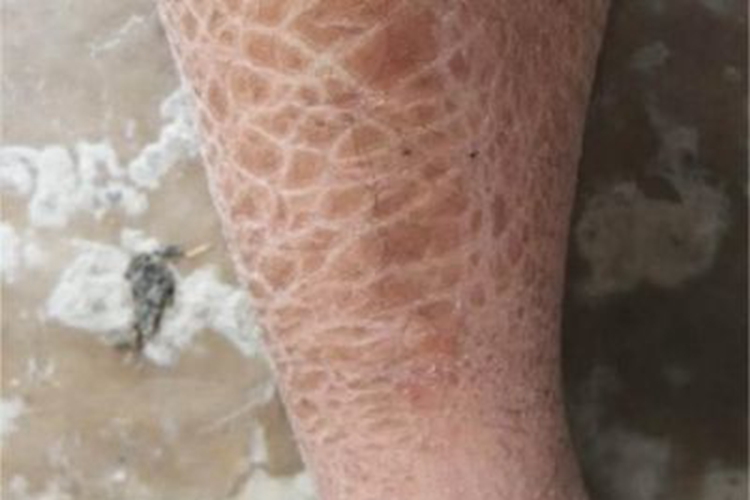 寻常型鱼鳞病小腿有深褐色斑图