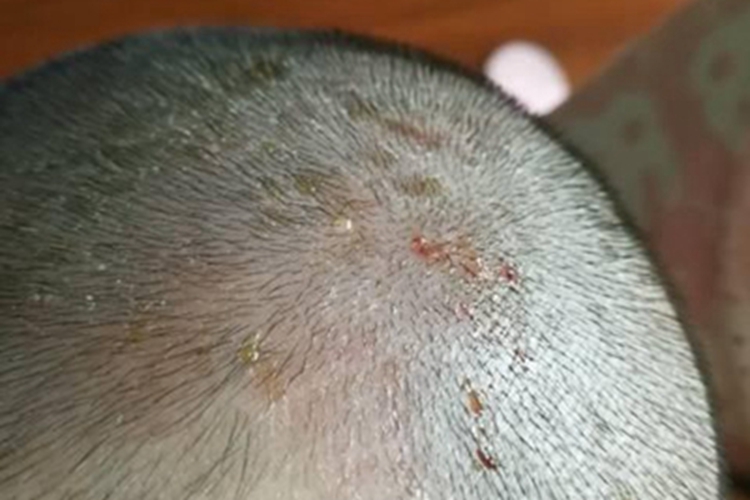 渗出型婴儿湿疹头皮黄痂图