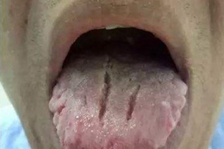 裂纹舌舌头症状图