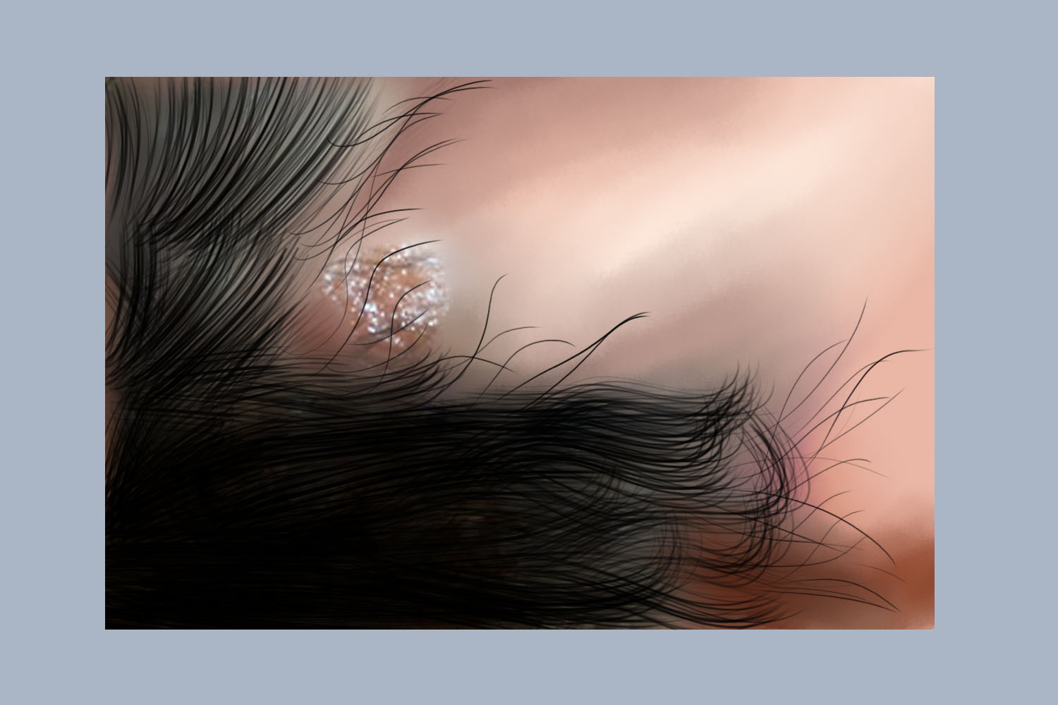 亚临床型生殖器疱疹破皮图 亚临床型生殖器疱疹破皮图