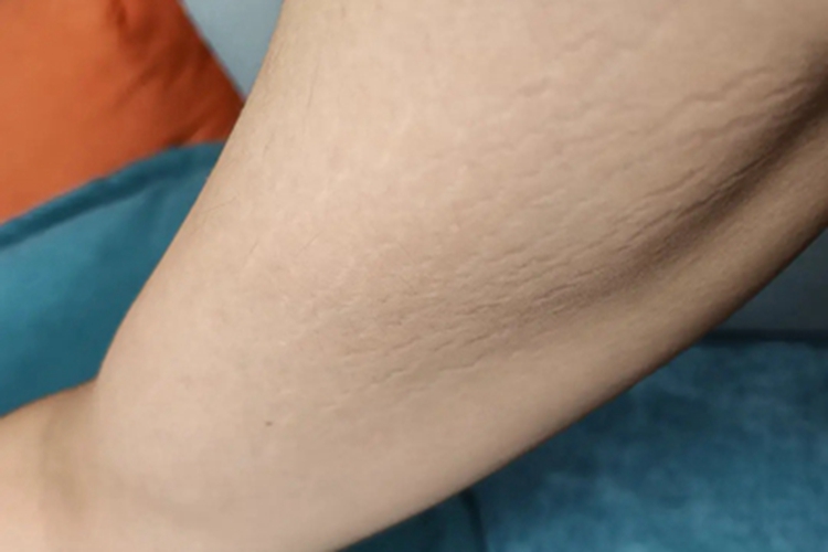 萎缩纹胳膊皮肤像裂开一样图 萎缩纹胳膊皮肤像裂开一样图