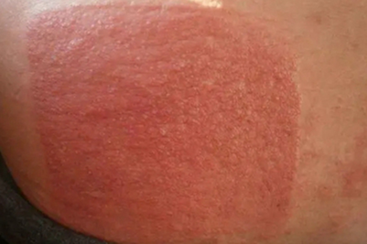 急性接触性皮炎腰部丘疹图