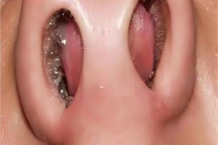 鼻中隔血肿包块图