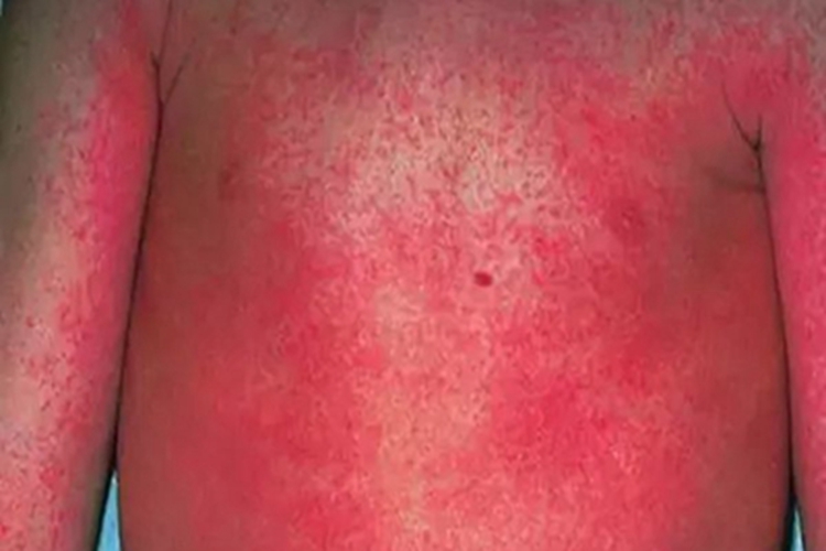 猩红热型药疹丘疹图