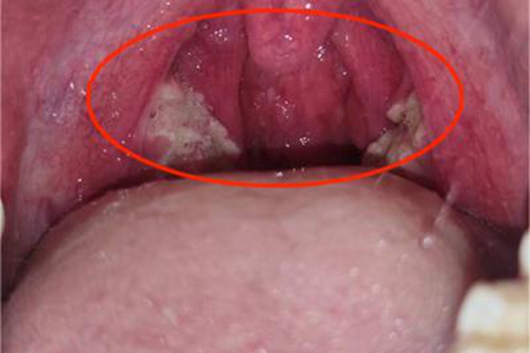 扁桃体炎咽喉红肿图