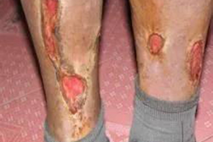 热带溃疡小腿溃烂图 热带溃疡小腿溃烂图