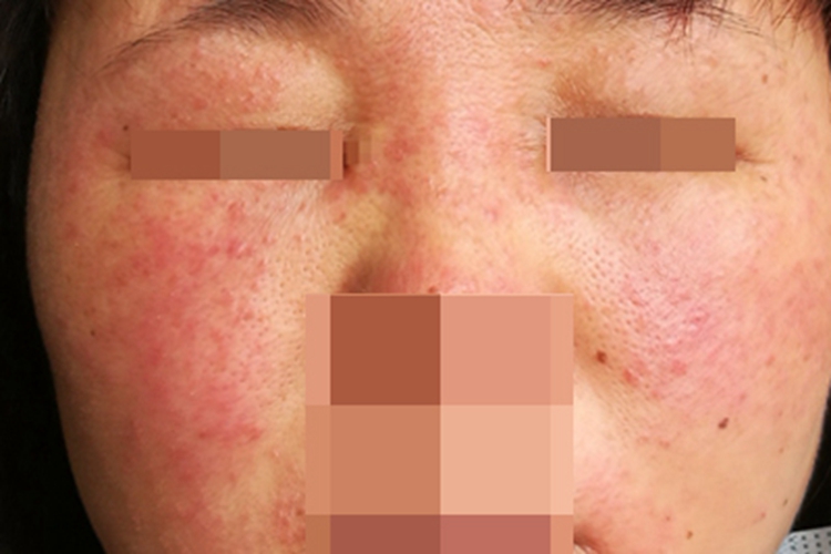 季节性接触性皮炎面部症状图