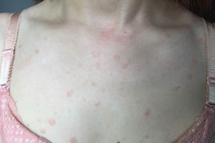 前胸汗斑初期症状图