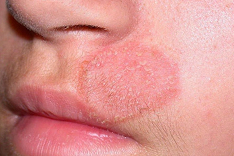 体癣口周症状图