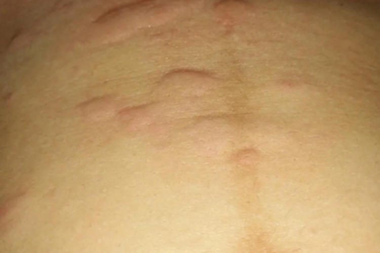 皮肤过敏红肿腹部症状图