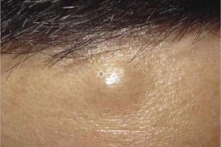 皮下脂肪瘤额头长疙瘩图 皮下脂肪瘤额头长疙瘩图