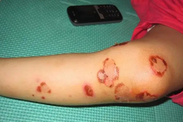 幼年型类天疱疮糜烂图