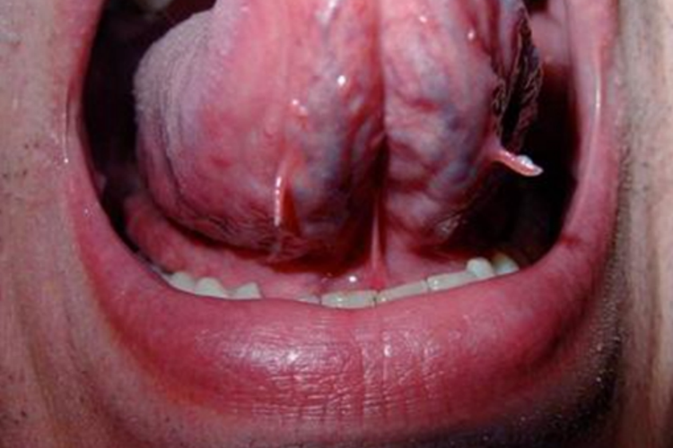 口腔尖锐湿疣图