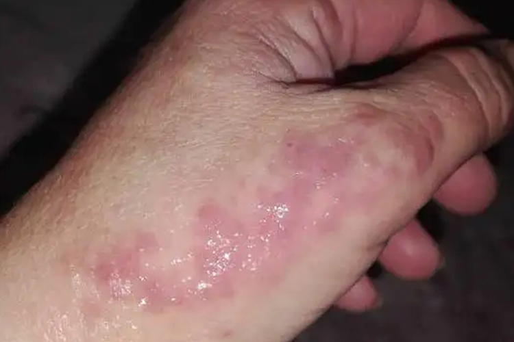 粉笔过敏手指水疱渗出图