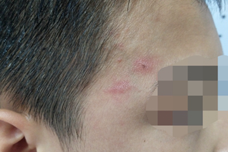 擦伤面部有两片红斑图 擦伤面部有两片红斑图