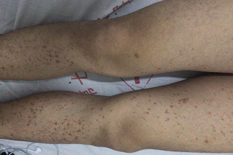 关节型过敏性紫癜图