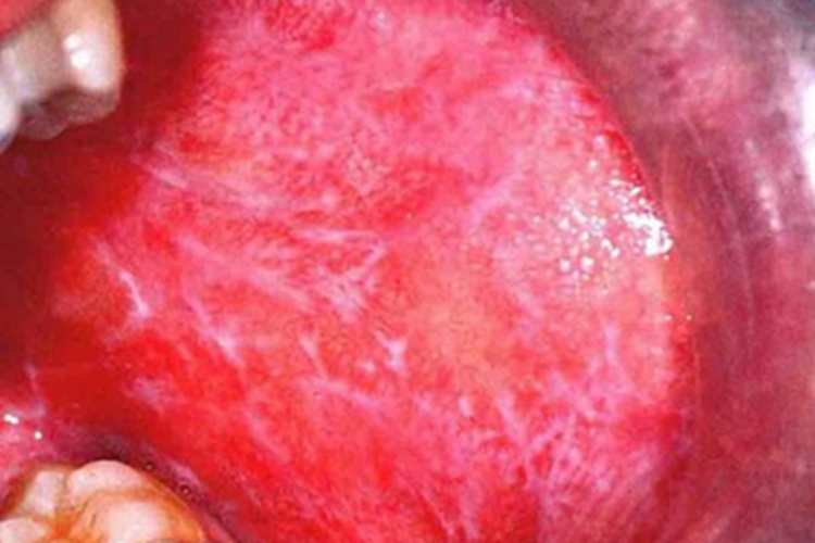 扁平苔藓口腔黏膜白条条纹图 扁平苔藓口腔黏膜白条条纹图