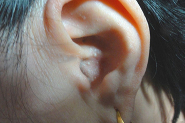 继发性粟丘疹耳部症状图 继发性粟丘疹耳部症状图