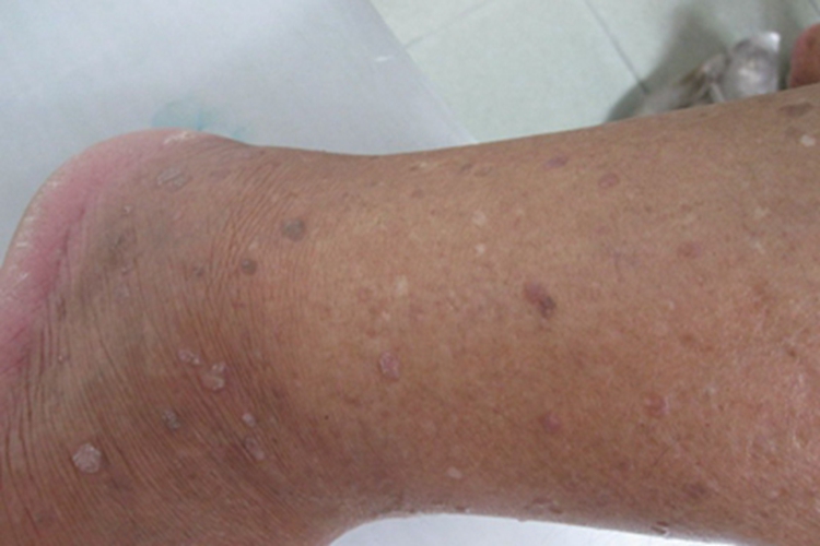 疣状肢端角化病症状图