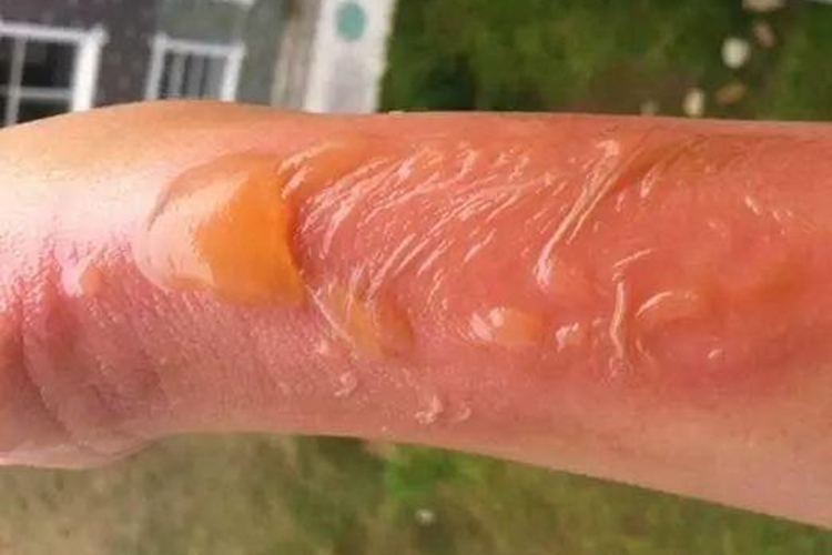 葡萄球菌性烫伤样皮肤综合征图 葡萄球菌性烫伤样皮肤综合征图