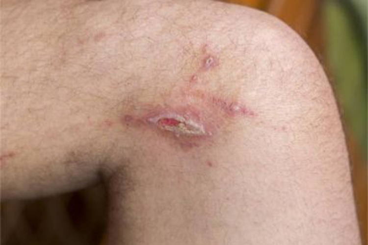 慢性接触性皮炎小腿溃疡图