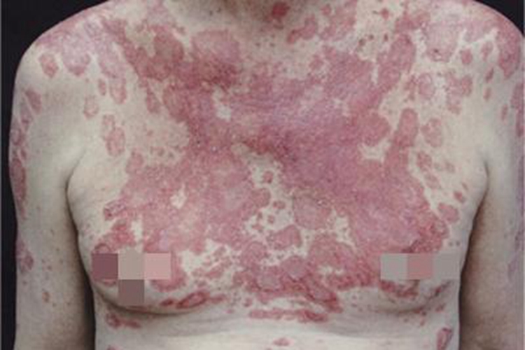 亚急性皮肤型红斑狼疮症状图