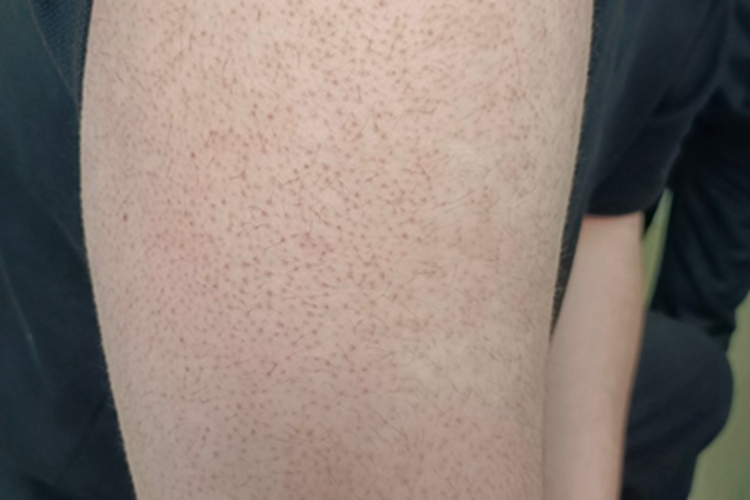 毛发扁平苔藓长丘疹图