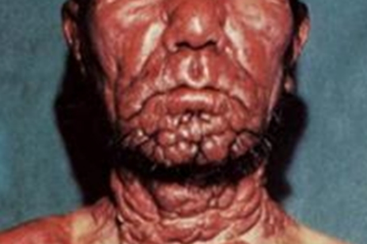 内脏利什曼病大红疙瘩图 内脏利什曼病大红疙瘩图