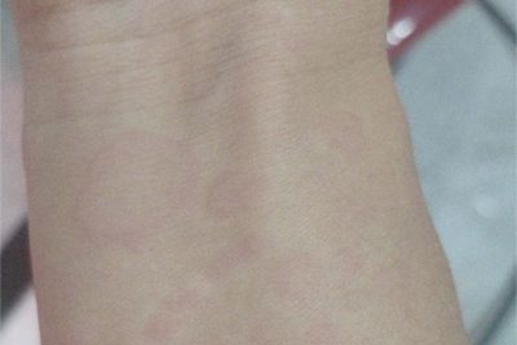 离心性环状红斑手腕上有圆圈图