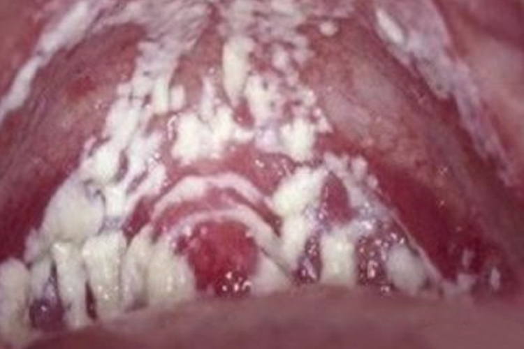 外阴阴道假丝酵母菌病阴道白带图